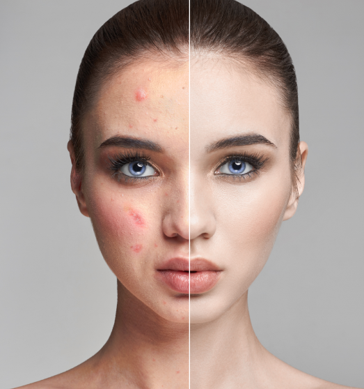 acne-img-1