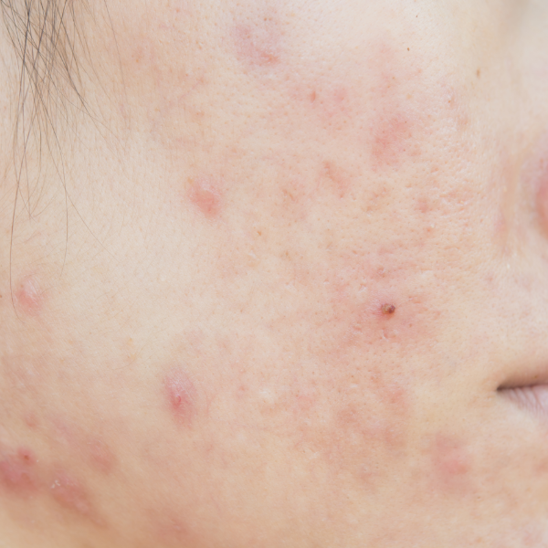 skin-concern-1