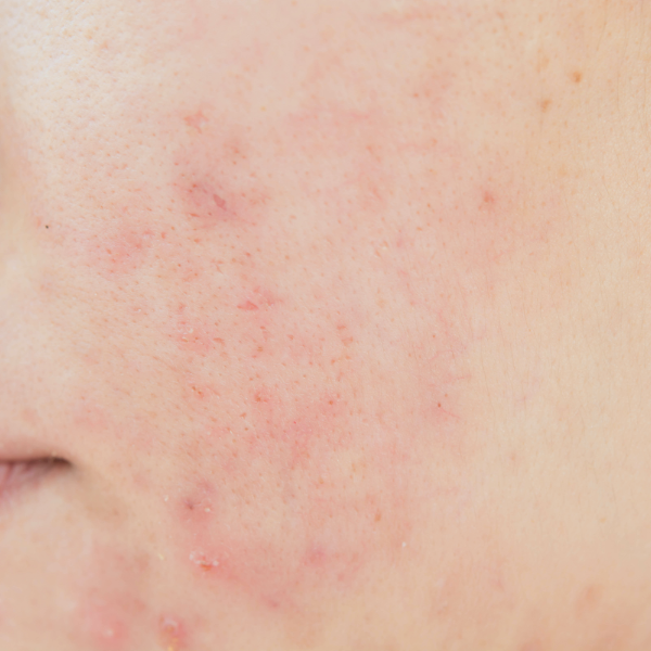 skin-concern-4